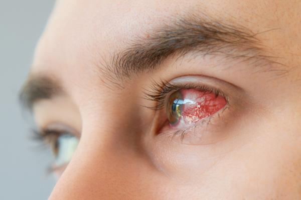 Mancha blanca en el iris del ojo: causas y tratamiento - Queratitis
