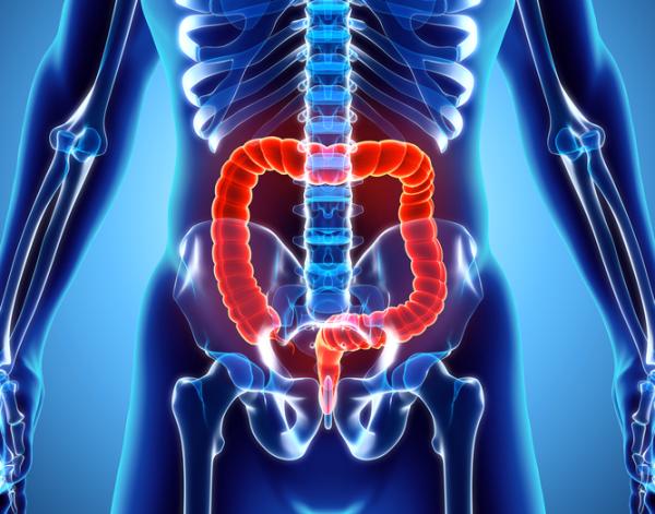 Megacolon tóxico: síntomas, causas y tratamiento