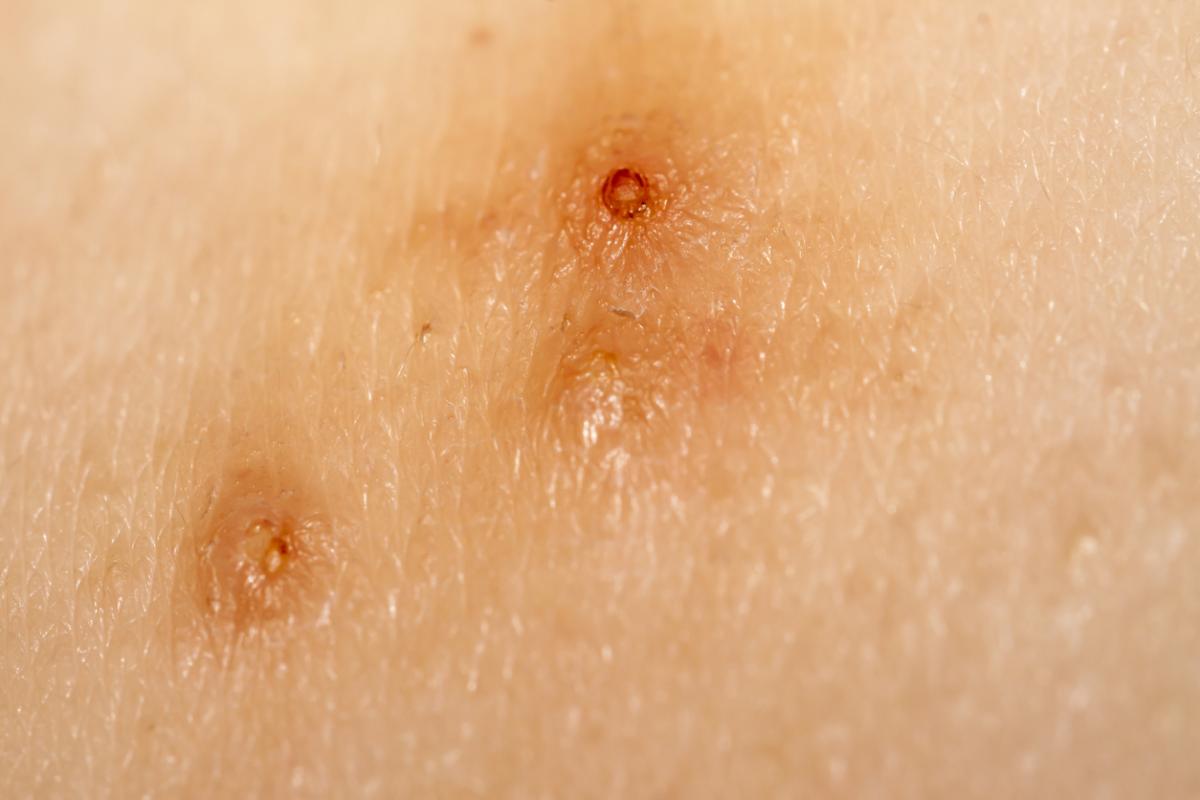 ¿Puedo tener molusco contagioso y mi pareja no?