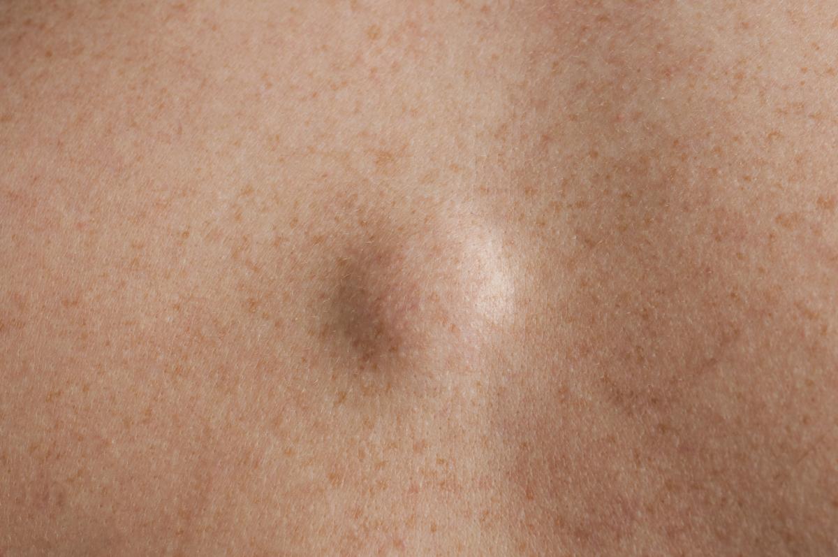 Lipoma en la axila: qué es, causas y tratamiento