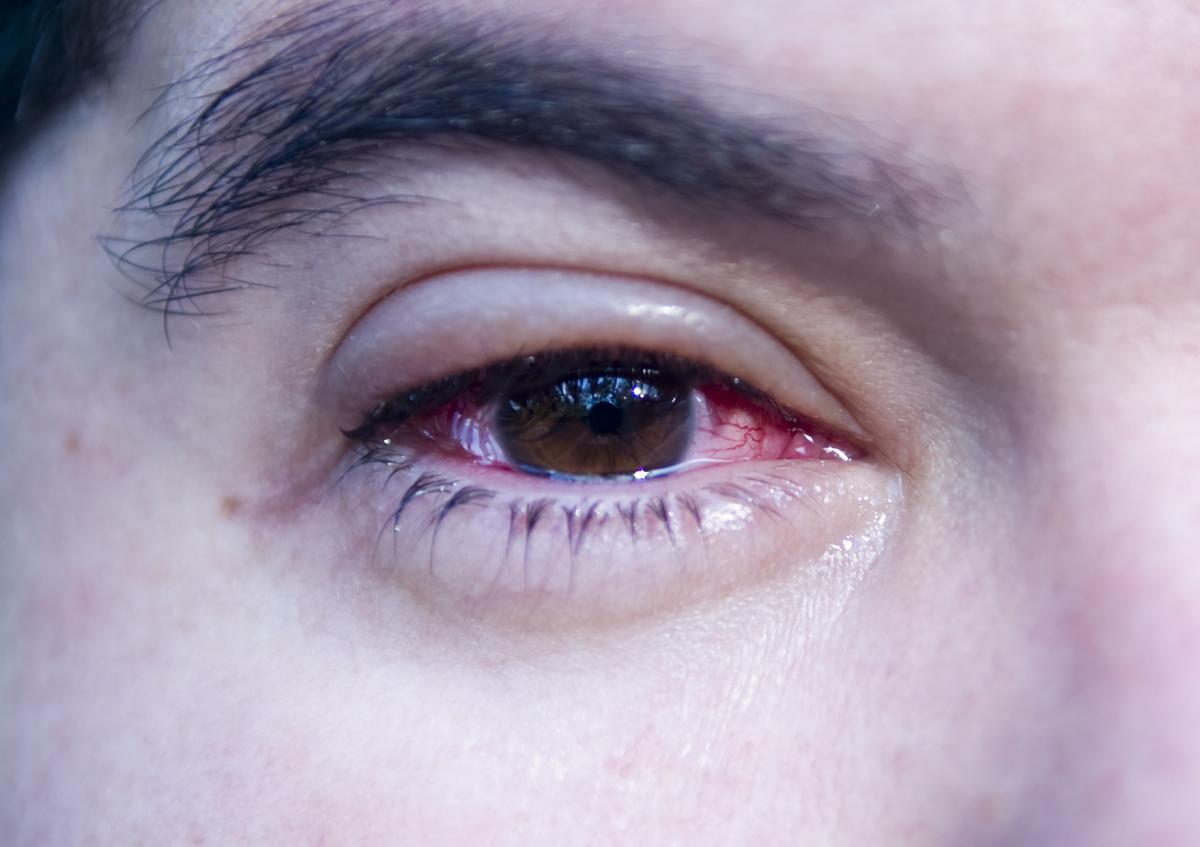Tengo un ojo hinchado y el otro no: ¿a qué se debe?