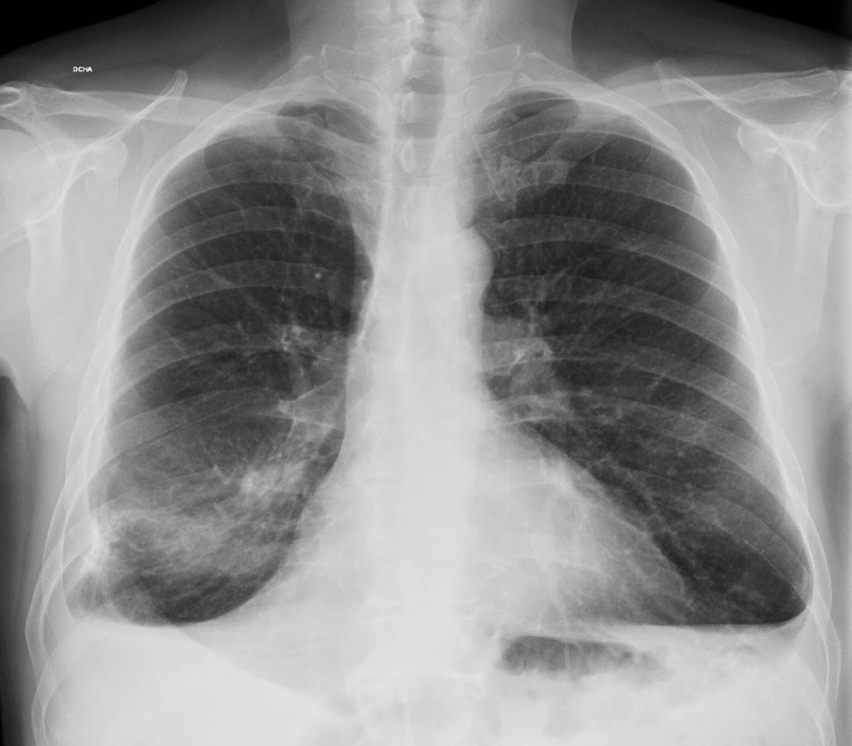 ¿El derrame pleural es peligroso?