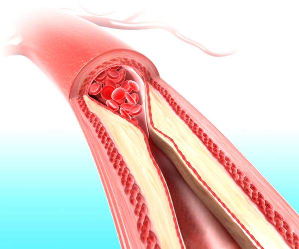 Colesterol alto: causas y tratamiento