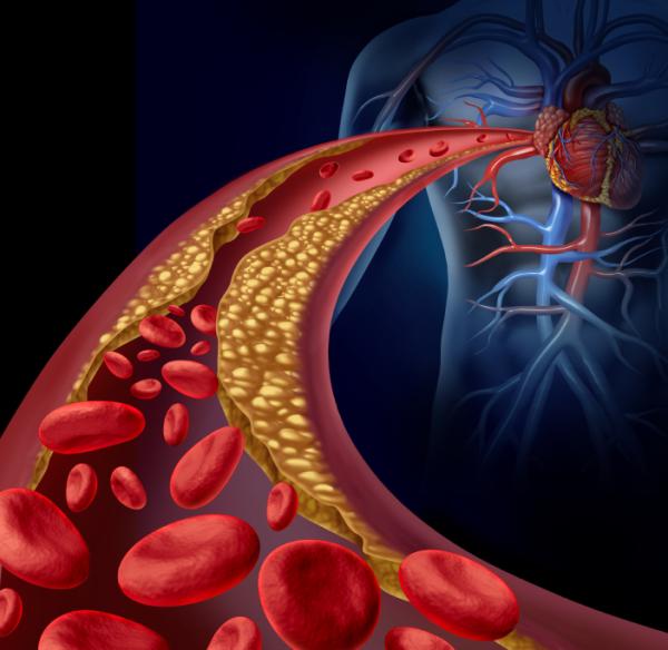 Angina de pecho: causas, síntomas y tratamiento - Algunas causas de angina de pecho