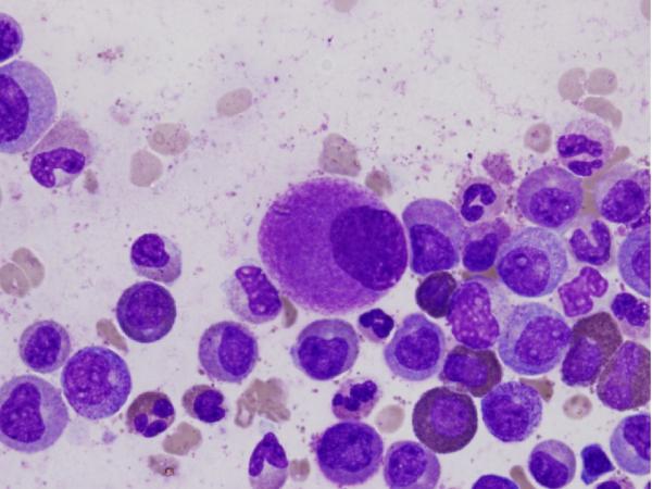 Leucemia mieloide crónica: causas, síntomas y pronóstico