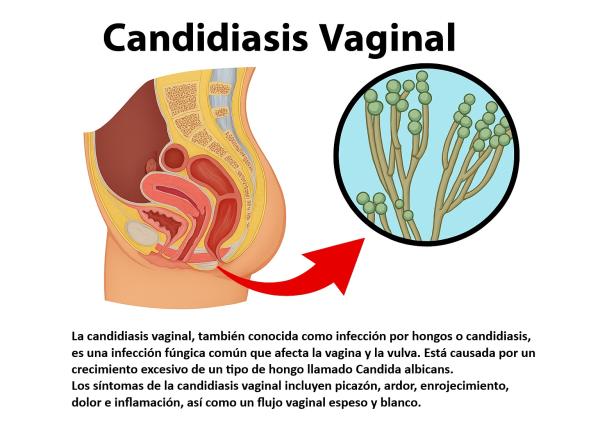 Úlceras genitales por candidiasis: síntomas y tratamiento
