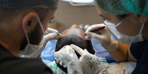 Terapia con exosomas y mesoterapia capilar: combate la alopecia con las técnicas de vanguardia de EVO Beauty Clinics