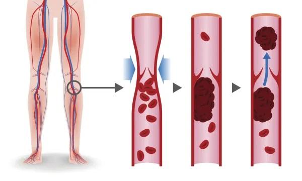 Picor en piernas y brazos: causas y tratamiento - Mala circulación