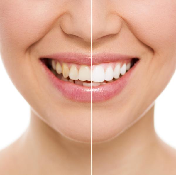 Remedios para eliminar el sarro dental - Eliminar el sarro con agua oxigenada y bicarbonato
