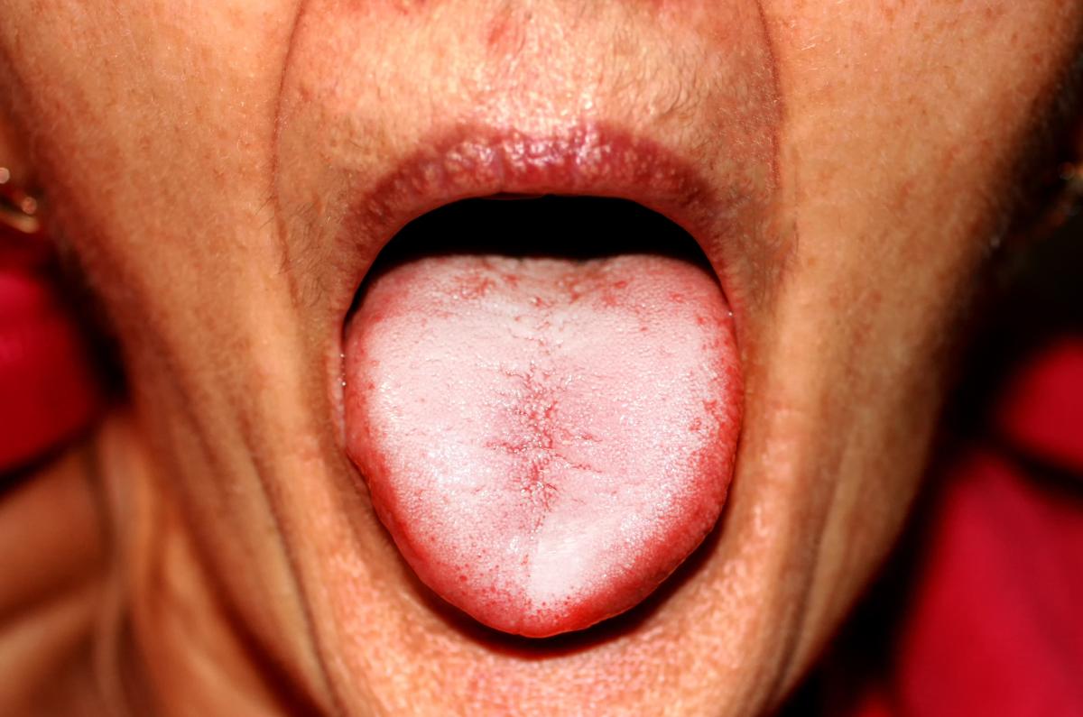 Lengua blanca y mal aliento: causas y tratamiento