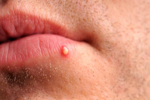 Grano blanco en el labio: causas, tratamientos y cuándo preocuparse