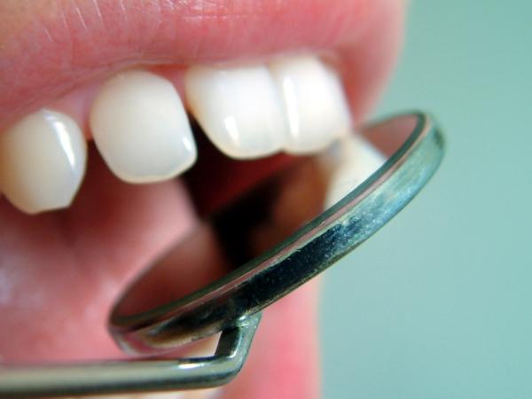 Gingivitis: causas, síntomas y tratamiento - Causas de la gingivitis 