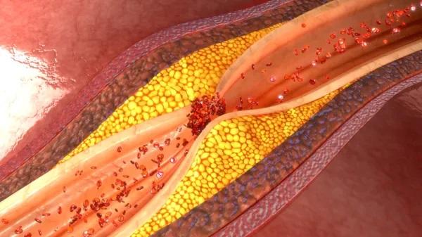 ¿Por qué se ponen las orejas rojas con la tensión alta? - ¿Qué es la presión arterial alta?