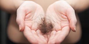 Remedios caseros para la alopecia areata