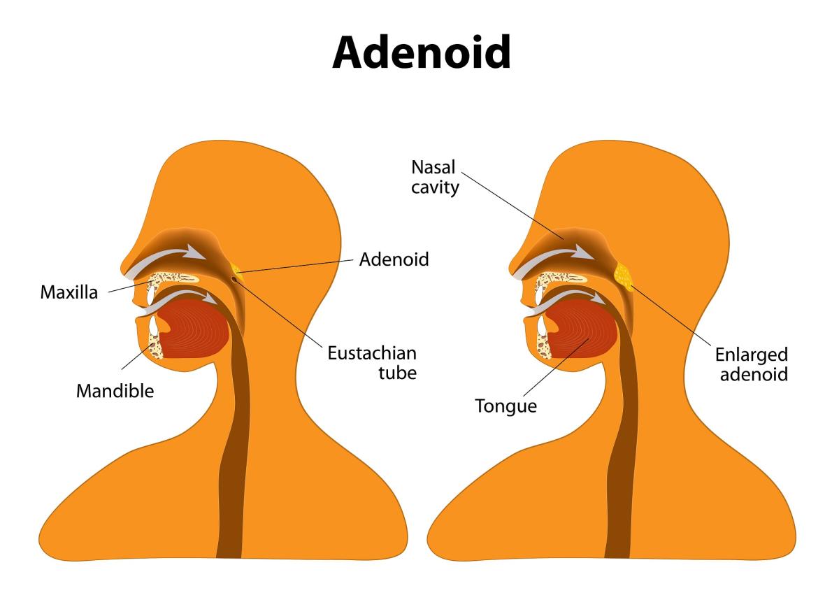 Adenoides inflamadas: síntomas, causas y tratamiento