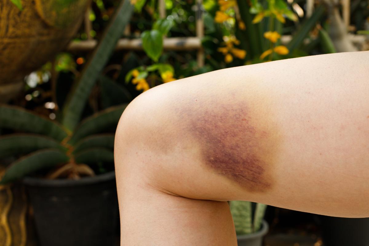 Cómo quitar moretones en las piernas rápido