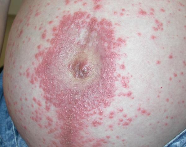 Picazón en la piel en el embarazo: causas - Herpes gestationis 