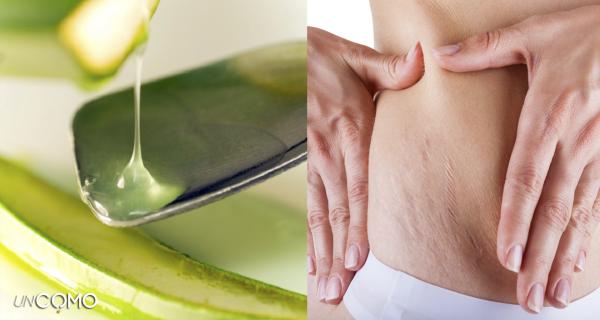 Cómo eliminar las estrías con aloe vera