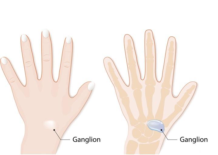 GANGLIÓN en la MANO: Causas y Tratamiento