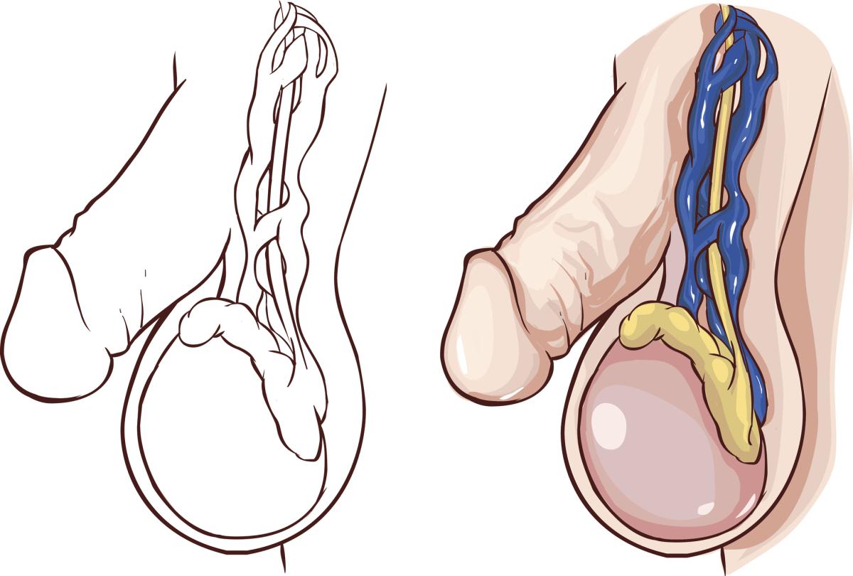 Por qué salen varices en los testículos
