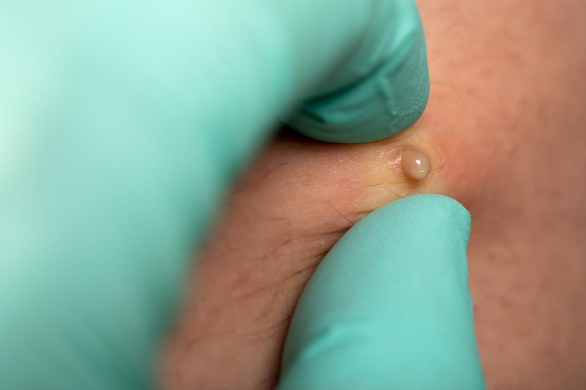 Cómo eliminar la foliculitis en los glúteos