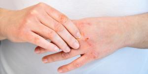 Eczema en las manos: causas, tratamiento y remedios