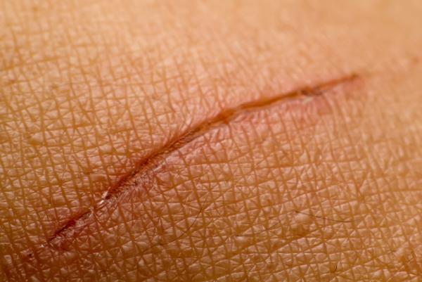 Beneficios de la miel de brezo - Beneficios para las heridas