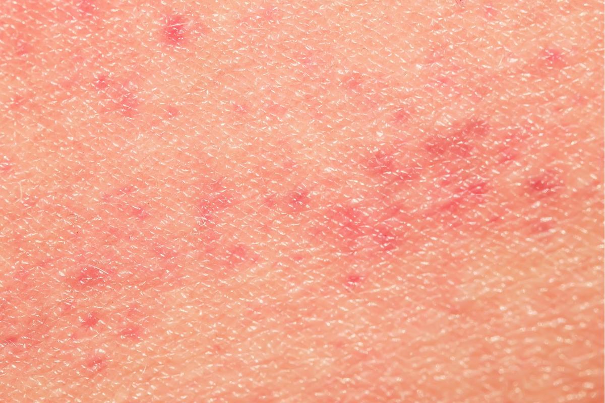 Puntos rojos en la piel por estrés: causas y tratamiento