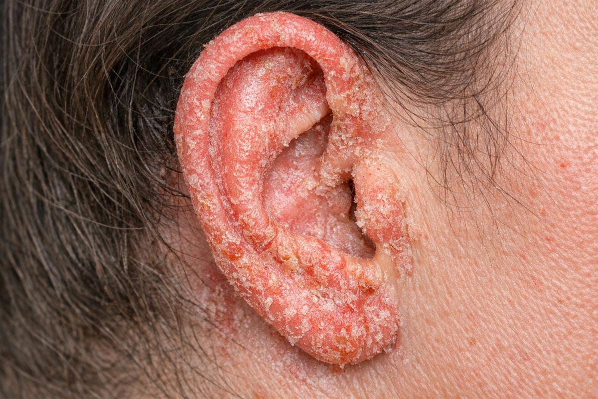 Eczema en las orejas: causas, síntomas y tratamiento eficaz