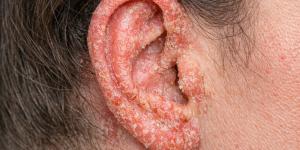 Eczema en las orejas: causas, síntomas y tratamiento eficaz