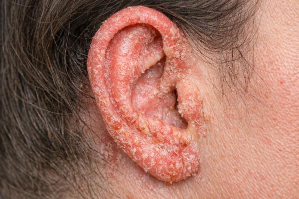 Eczema en las orejas: causas, síntomas y tratamiento eficaz
