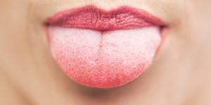 Hongos en la lengua: por qué salen, síntomas, tratamientos y remedios