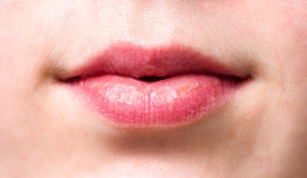 Por qué se resecan los labios