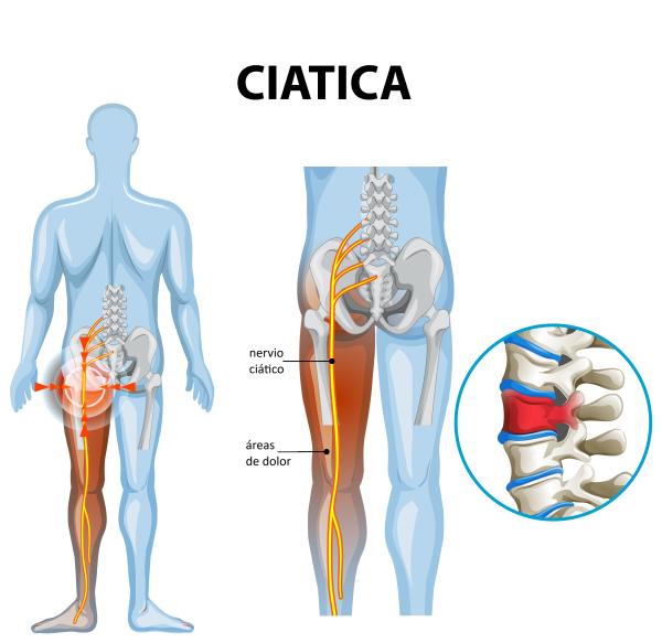 ¿Es bueno andar para la ciática? - Qué es el dolor del ciático o ciatalgia