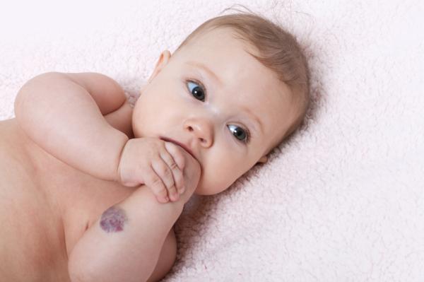 Manchas rojas en la piel: causas - Hemangioma