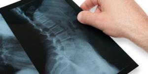 Ejercicios recomendados para la escoliosis
