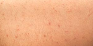 Foliculitis en las piernas: causas, tratamiento y remedios caseros