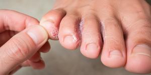 Hongos entre los dedos de los pies: síntomas, causas y tratamientos