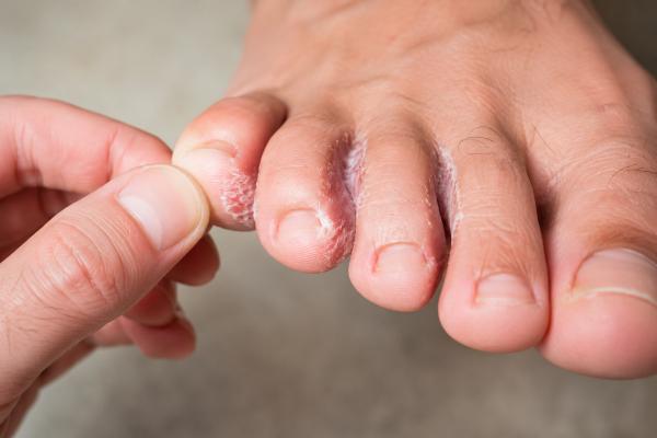 Hongos entre los dedos de los pies: síntomas, causas y tratamientos