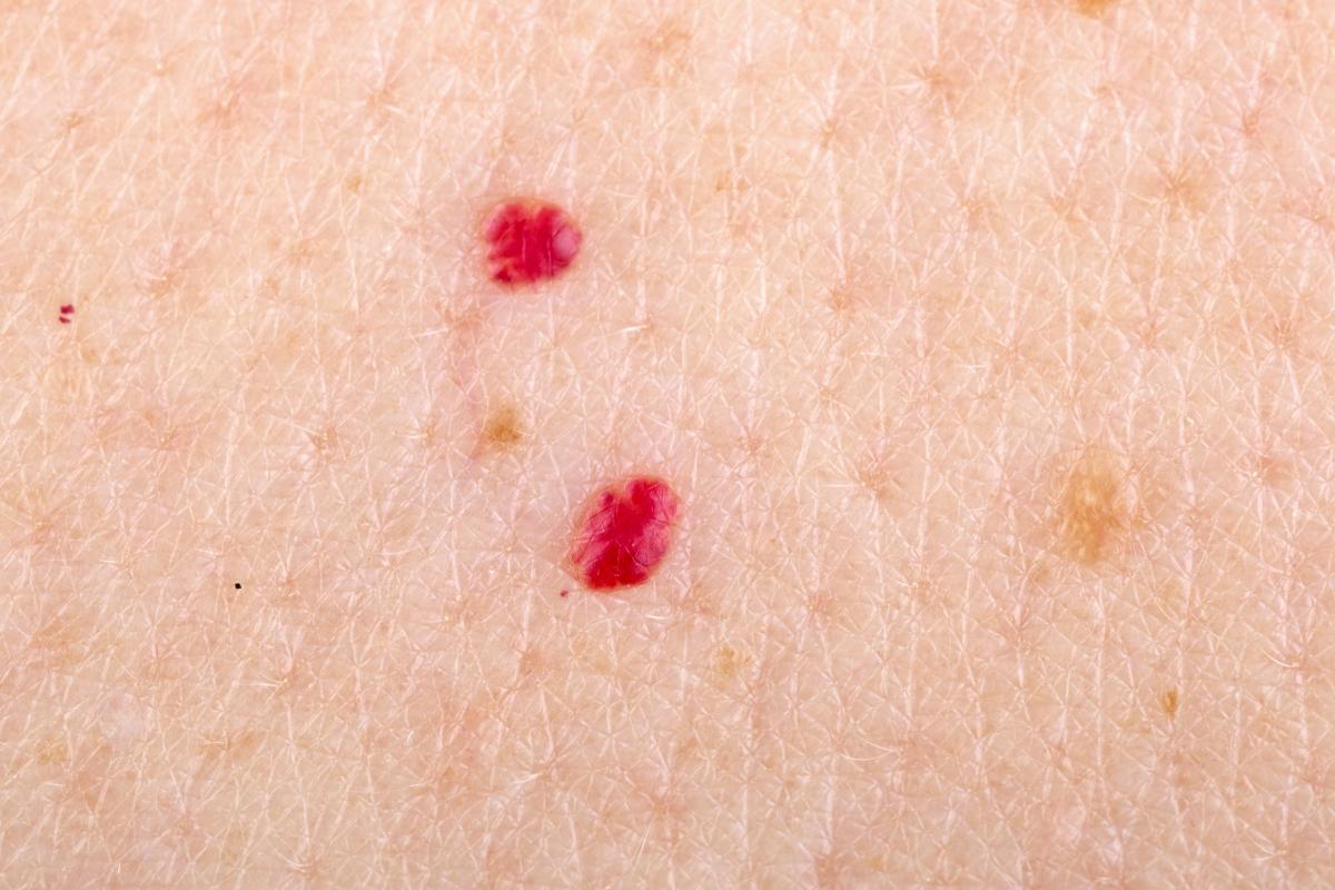 Por qué tengo un lunar rojo en el pecho y qué hacer
