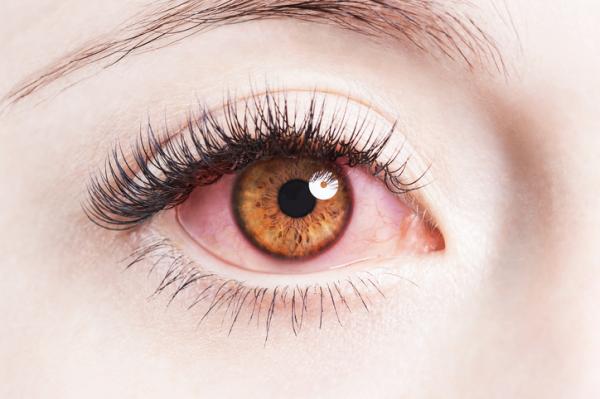 Remedios caseros para los ojos rojos e irritados