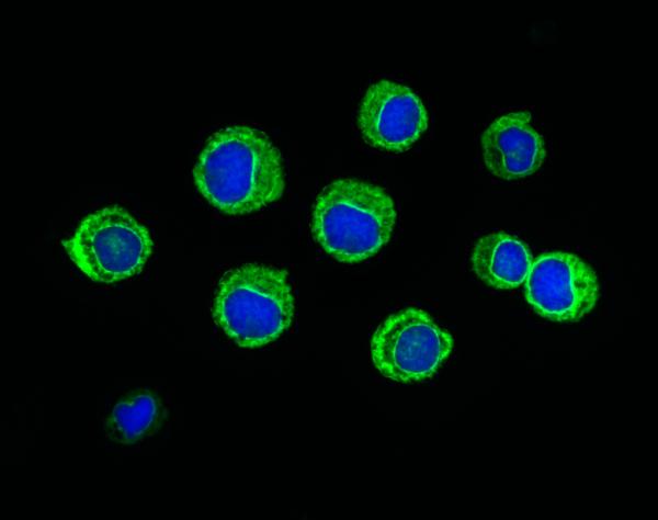 Leucemia linfocítica crónica: causas, síntomas y pronóstico