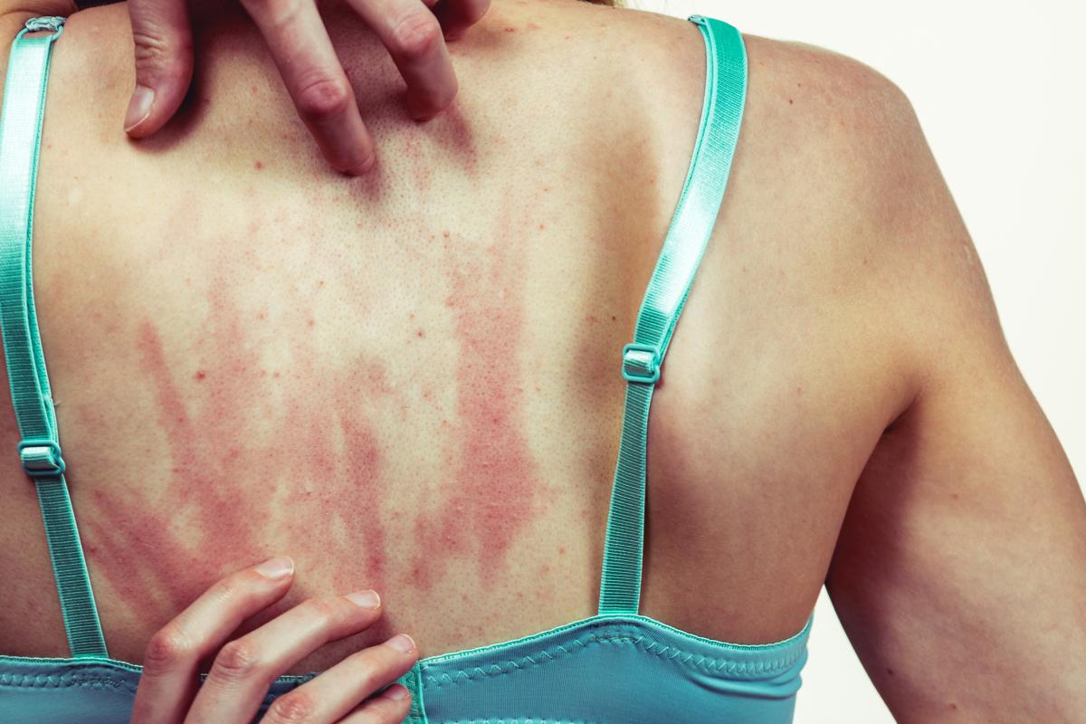 Picor en todo el cuerpo sin ronchas: causas y tratamiento