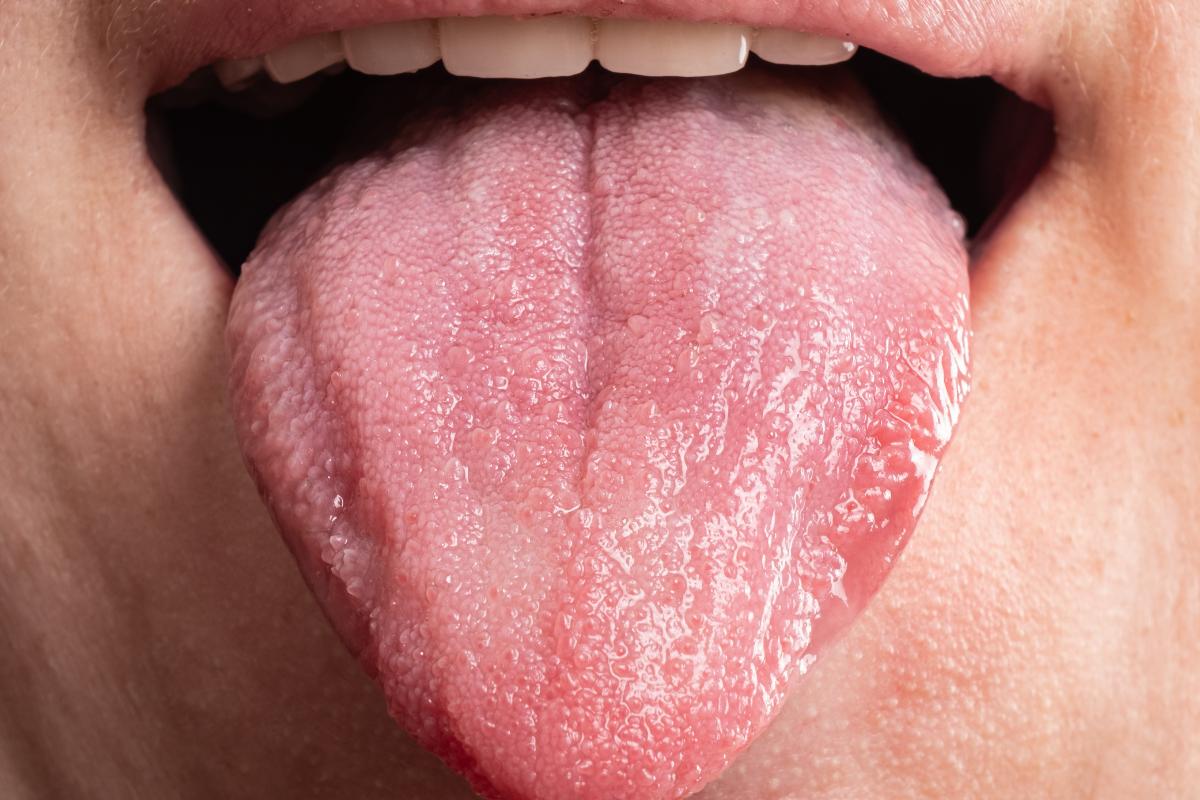 Granitos en la lengua: ¿Por qué salen y cómo quitarlos?