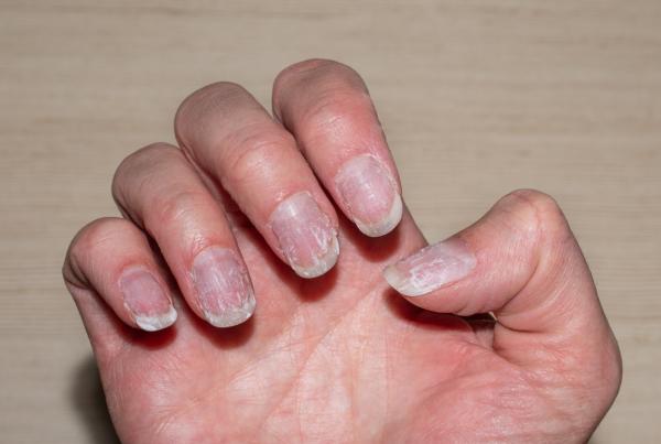 Uñas dañadas por el torno: causas y soluciones - Exceso de presión