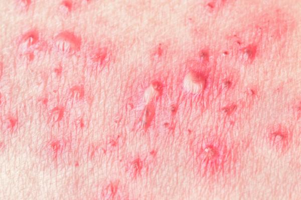 Dolor en la axila: causas y tratamientos - Herpes zóster