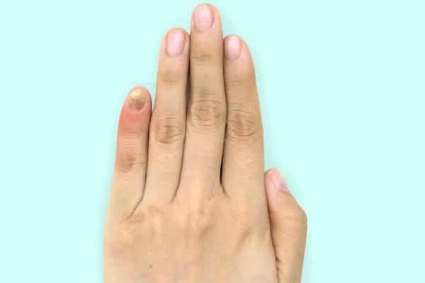 Uñas dañadas por el torno: causas y soluciones - Infecciones en las uñas