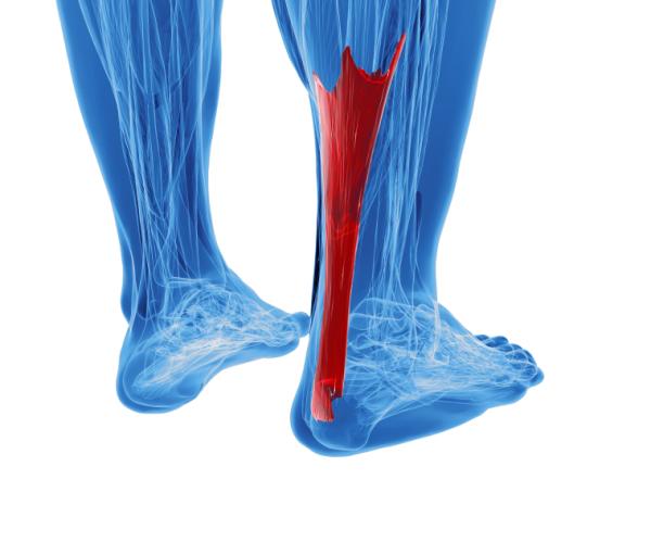 Dolor en el talón: causas - Tendinitis aquílea