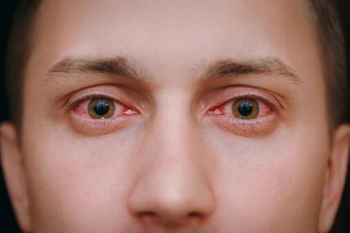 Por qué tengo los ojos rojos al despertar