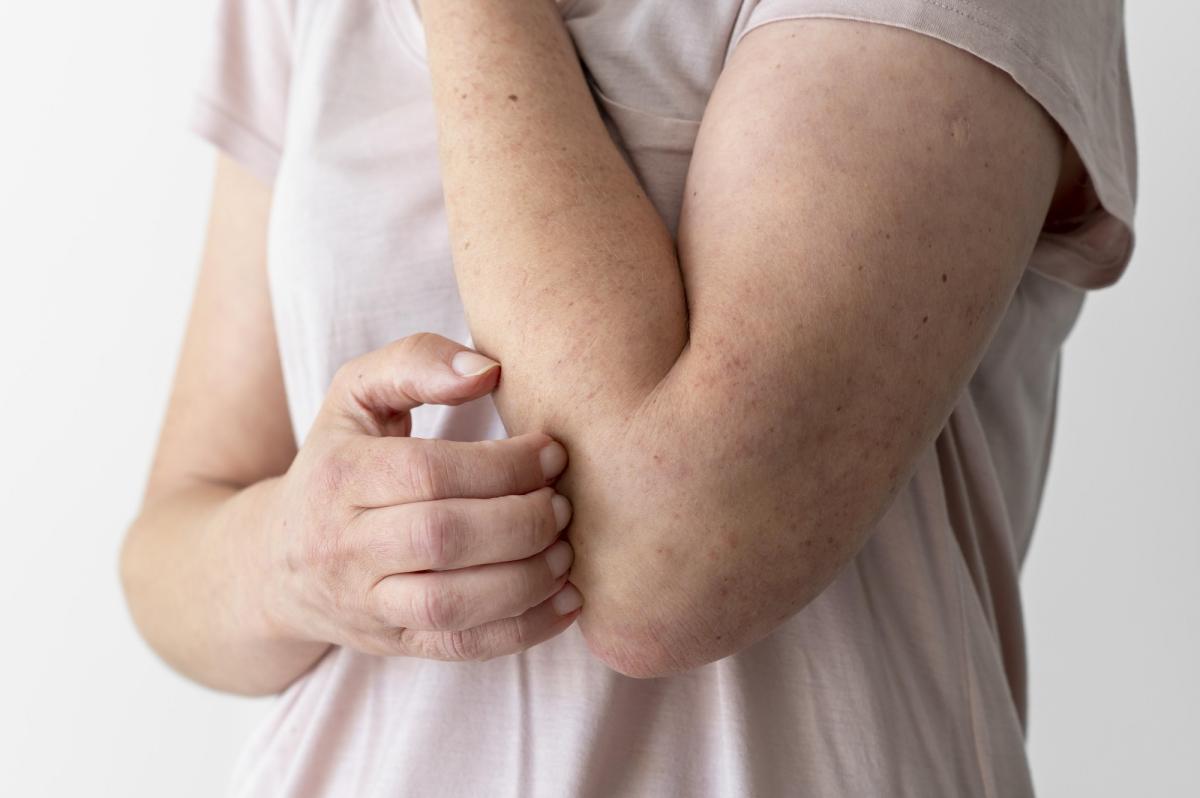Tipos de queratosis y su tratamiento